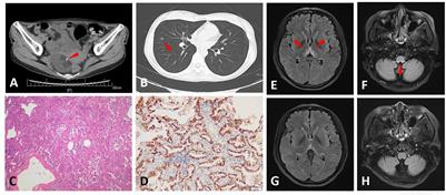 Neuromyelitis optica spectrum disorders associated with AQP4-positive-cancer—A case series